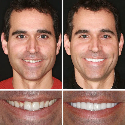 SmileLock – Solución premium de prótesis dentales completas