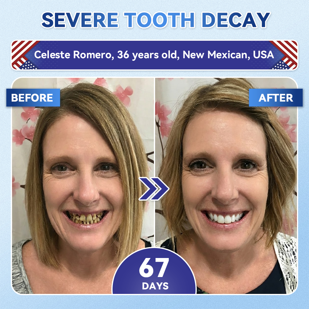 Ihr Lächeln~ NESLEMY® 🦷 Tideglusib Zahn- & Zahnfleisch-Reparatur-Streifen mit Sofortauflösung ✨ (𝟓-𝐢𝐧-𝟏 💎 𝐙𝐚𝐡𝐧𝐬𝐜𝐡𝐦𝐞𝐥𝐳- & 𝐃𝐞𝐧𝐭𝐢𝐧𝐚𝐮𝐟𝐛𝐚𝐮 • 𝐙𝐚𝐡𝐧𝐟𝐥𝐞𝐢𝐬𝐜𝐡𝐬𝐭ä𝐫𝐤𝐮𝐧𝐠 • 𝐁𝐞𝐬𝐞𝐢𝐭𝐢𝐠𝐮𝐧𝐠 𝐯𝐨𝐧 𝐙𝐚𝐡𝐧𝐬𝐭𝐞𝐢𝐧 & 𝐌𝐮𝐧𝐝𝐠𝐞𝐫𝐮𝐜𝐡 • 𝐀𝐮𝐟𝐡𝐞𝐥𝐥𝐮𝐧𝐠 • 𝐒𝐭𝐨𝐩𝐩𝐭 𝐙𝐚𝐡𝐧𝐞𝐦𝐩𝐟𝐢𝐧𝐝𝐥𝐢𝐜𝐡𝐤𝐞𝐢𝐭)