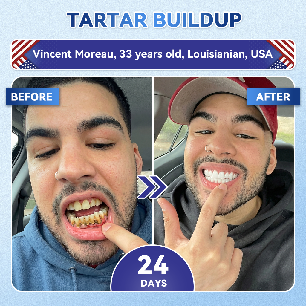 Ihr Lächeln~ NESLEMY® 🦷 Tideglusib Zahn- & Zahnfleisch-Reparatur-Streifen mit Sofortauflösung ✨ (𝟓-𝐢𝐧-𝟏 💎 𝐙𝐚𝐡𝐧𝐬𝐜𝐡𝐦𝐞𝐥𝐳- & 𝐃𝐞𝐧𝐭𝐢𝐧𝐚𝐮𝐟𝐛𝐚𝐮 • 𝐙𝐚𝐡𝐧𝐟𝐥𝐞𝐢𝐬𝐜𝐡𝐬𝐭ä𝐫𝐤𝐮𝐧𝐠 • 𝐁𝐞𝐬𝐞𝐢𝐭𝐢𝐠𝐮𝐧𝐠 𝐯𝐨𝐧 𝐙𝐚𝐡𝐧𝐬𝐭𝐞𝐢𝐧 & 𝐌𝐮𝐧𝐝𝐠𝐞𝐫𝐮𝐜𝐡 • 𝐀𝐮𝐟𝐡𝐞𝐥𝐥𝐮𝐧𝐠 • 𝐒𝐭𝐨𝐩𝐩𝐭 𝐙𝐚𝐡𝐧𝐞𝐦𝐩𝐟𝐢𝐧𝐝𝐥𝐢𝐜𝐡𝐤𝐞𝐢𝐭)