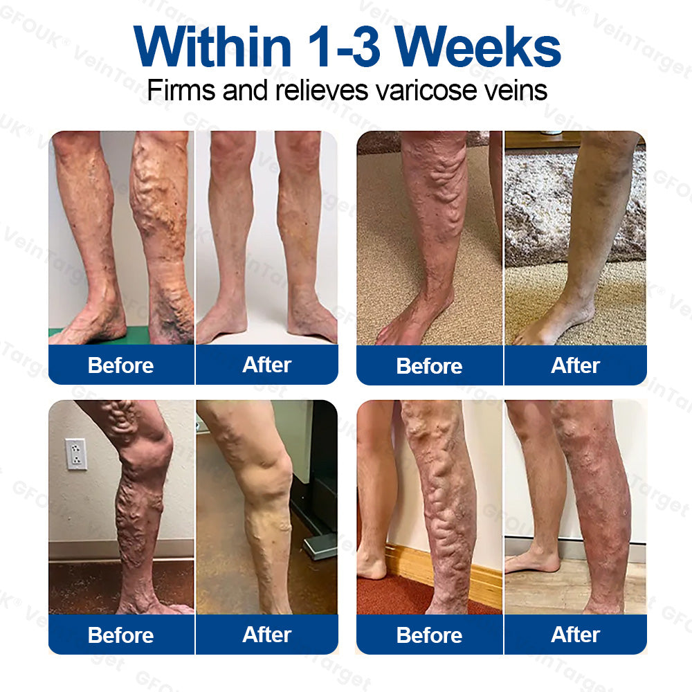 🇪🇸👨‍⚕️✅✅Parche de Microneedles GFOUK® VeinTarget⚡Alivio Instantáneo, Resultados a Largo Plazo