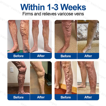 🇪🇸👨‍⚕️✅✅Parche de Microneedles GFOUK® VeinTarget⚡Alivio Instantáneo, Resultados a Largo Plazo