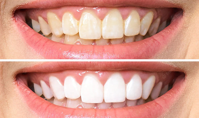 AuraBright – Tiras blanqueadoras de dientes avanzadas PAP+