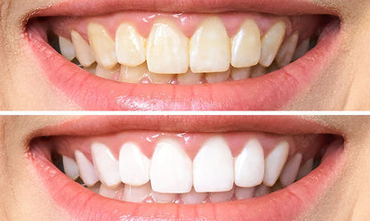 AuraBright – Tiras blanqueadoras de dientes avanzadas PAP+