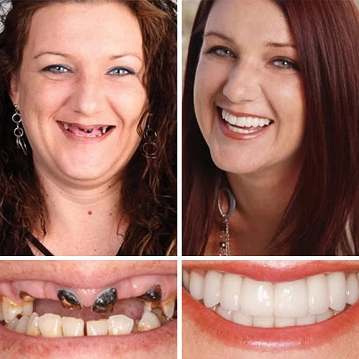 SmileLock – Solución premium de prótesis dentales completas