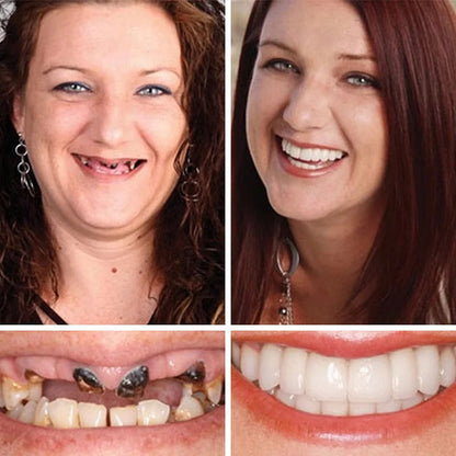 SmileLock – Solución premium de prótesis dentales completas