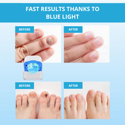 LaserNail Pro | Tratamiento contra los hongos