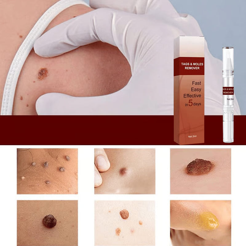 ClearGuard – Lápiz eficaz para eliminar verrugas