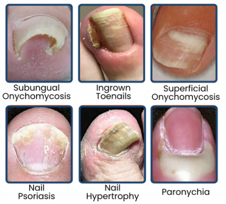 NailRevive Pro – Parches de Cuidado Profundo