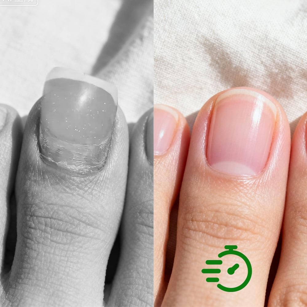 VitaNail – Intensiv-Stift gegen Nagelpilz