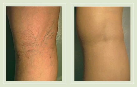 GlowLegs – Corrector de Piernas con Acabado Aerografiado