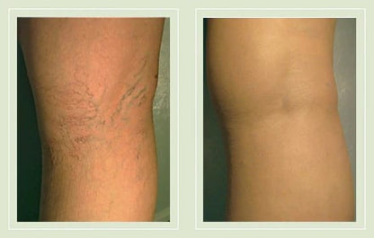 GlowLegs – Corrector de Piernas con Acabado Aerografiado