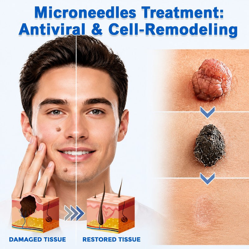 SkinNova – Parche para Acné con Microneedles de Doble Acción